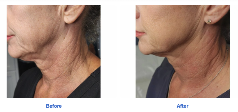 Sofwave non-surgical facelift Tribeca NYC