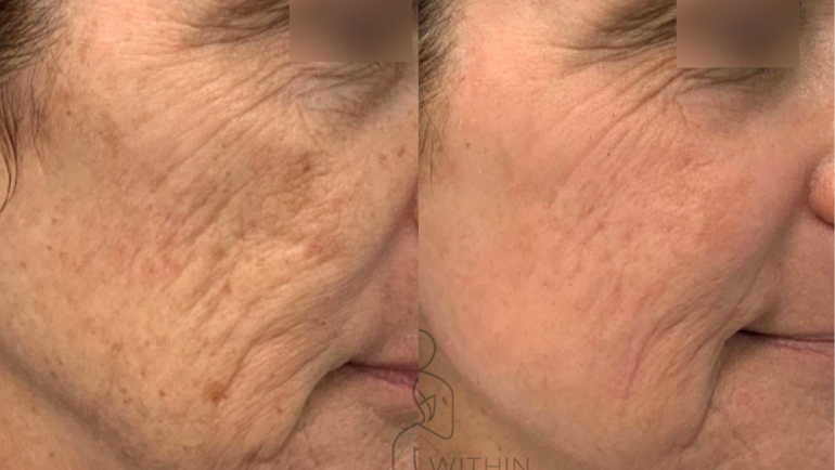 Ultraclear Laser treatments New York