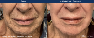 Ultraclear Laser skin resurfacing New York