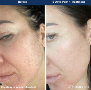 laser resurfacing nyc