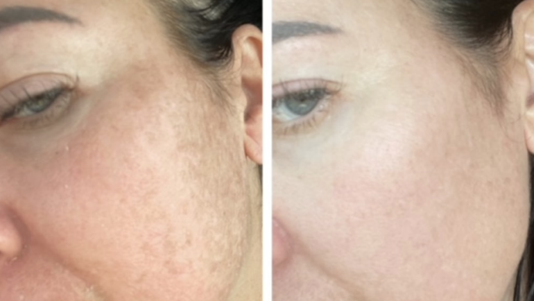 laser resurfacing nyc