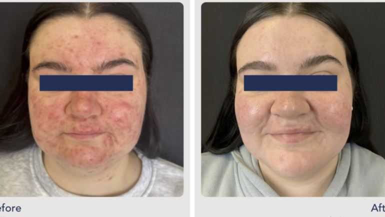 aviclear in nyc results