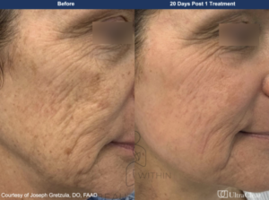 laser skin resurfacing NYC