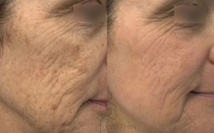 laser skin resurfacing NYC